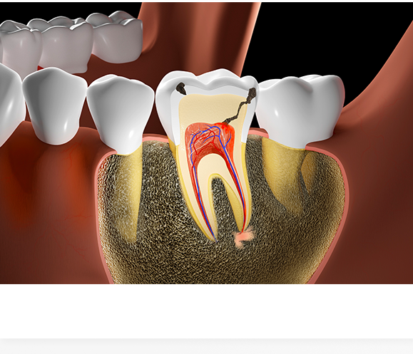 심한 충치로 신경치료를 받은 경우